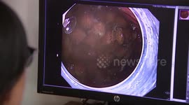 宁波：男子腹胀一个月 竟是100多颗杨梅核“藏”胃里