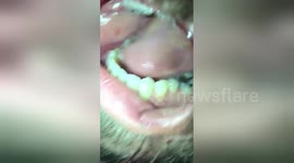 Abscess floods man's mouth with yellow pus