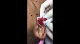 Stomach-churning moment doctor bursts giant pimple in man's ear