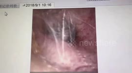 大连  蜘蛛钻进老大爷耳朵里  把耳道当成家在里面结网  素材