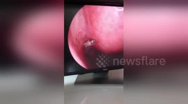 Stomach-churning footage shows twitching mosquito deep inside man's nose