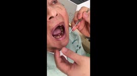Pebble found lodged on man's palate in Vietnam
