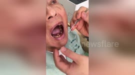 'Pebble' found lodged in man's palate in Vietnam