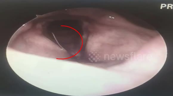 The Fish Bones 1 57 Inches Long In The Throat Of The Male Patient Buy Sell Or Upload Video Content With Newsflare
