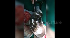 Surgeons remove 1.5kg lump of metal from Indian woman's stomach
