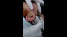 Treatment with surgical scalpel