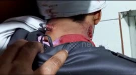 Miraculously survive as bullet shot iin neck  stuck from right to left in India.