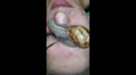 Snail's mucus in the fight against acne scars in combination with chemical peeling