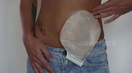 Mum embarks on mission to show people living with stomas don’t smell
