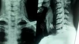 Doctors extract 3 inch-long chicken bone from man's throat in India