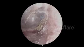 Tiny spider found building a nest in man’s ear in China in stomach-churning clip
