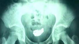 Chinese teen boy has 29 magnetic beads removed from bladder