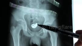 Chinese teen boy has 29 magnetic beads removed from bladder