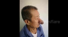 An elderly man in eastern China has seen his nose swell up due to alcoholism