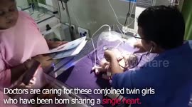 Conjoined twin girls just one day old share a single heart - and possibly a liver