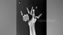 Thai doctor reveals how he salvaged man's mutilated hand