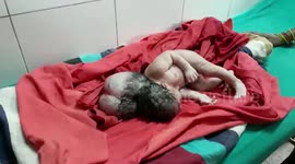 Doctors in India baffled as woman gives birth to girl 'with three heads'