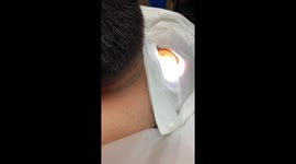 Getting a skin tag removed