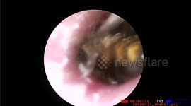 Doctor in Vietnam removes bee that was burrowing in man's ear