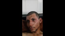 ‘The world must see’: Kurdish fighters suffering from severe burns claim Turkish forces used white phosphorus in airstrike during ceasefire
