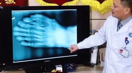 Chinese man with nine toes on one foot has surgery to remove the extras