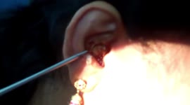 Woman has cockroach pulled out from her ear by doctor in south India