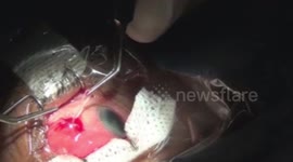Disturbing surgery footage shows Indian doctor extracting 7cm parasite from man's EYEBALL