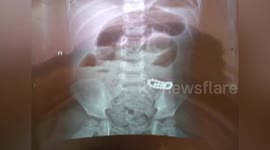 Doctor removes 22 magnetic balls from toddler's tummy in China