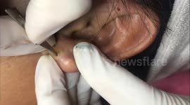 Dermatologist squeezes out giant acne spot on Vietnamese woman's ear