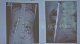 Thai medics stunned after finding six-inch long MAGNET in boy's stomach