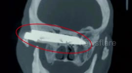 Chinese doctors remove knife blade from elderly man's head after after being stuck for 26 years