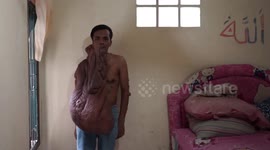A Young Man in Medan, Indonesia Has a Rare Disease That Can Kill Him