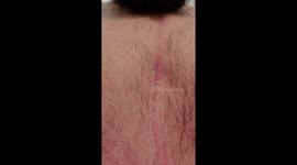 US man's 'partially artificial' heart seen beating through chest scar