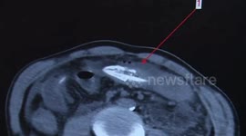 Chinese man almost dies after letting eel enter his anus to treat his constipation