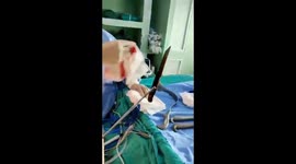 Man craving for Marijuana consumes kitchen knife, operated at AIIMS Delhi