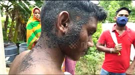 Snakebite victim left with horrific burns after undergoing controversial 