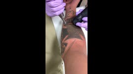 US man starts new chapter by removing Nazi-era Iron Cross hate tattoos