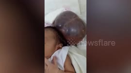 Two-month-old baby battling to survive after being born with brain bursting out of skull