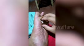 Filipino man uses dried blister on his foot as a secret pocket for money