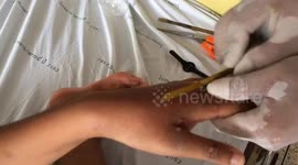 Paramedics battle to cut away ring stuck on girl's swollen finger