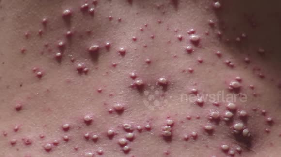 Newsflare Adult Chicken Pox