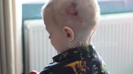 A toddler mauled by a dog miraculously survived - thanks to his woolly hat