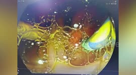 Doctors shocked after gallstones endoscopy procedure reveals WORM in patient’s stomach