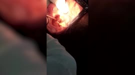 Live cricket pulled from woman's ear by doctor in central India