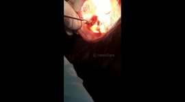 watch - Shocked Ent doctor treated out insect from a women ear in Dhamtari