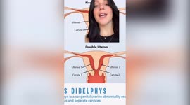 US student born with TWO VAGINAS can get pregnant without any symptoms