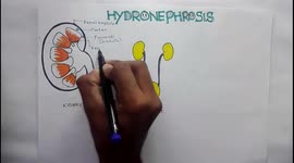 HYDRONEPHROSIS : Pathophysiology, Causes, signs and symptoms, background, diagnosis and treatment