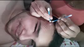 Sacando un grano en la frente me dolio mucho. Sigueme en mis redes