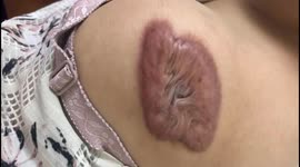 Vietnamese woman has a strange tumor on her shoulder