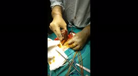 Woman survives four hour operation to remove AXE from her HEAD